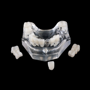 PB-5 Implant Crown & Bridge Combination - Avtec Dental