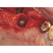 Dental Degranulation Burs - 3 Pack - Avtec Dental