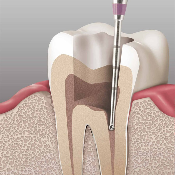 Long Neck Endo Access Bur, Carbide Cutting Tip, Round, 0.8mm Ø, Length 34mm, RA - HM191A-008-RAXL - Avtec Dental