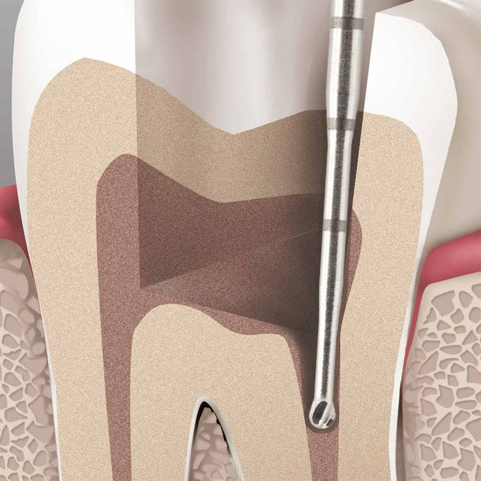 Long Neck Endo Access Bur, Carbide Cutting Tip, Round, 1mm Ø, Length 31mm, RA - HM191A-010-RAL - Avtec Dental