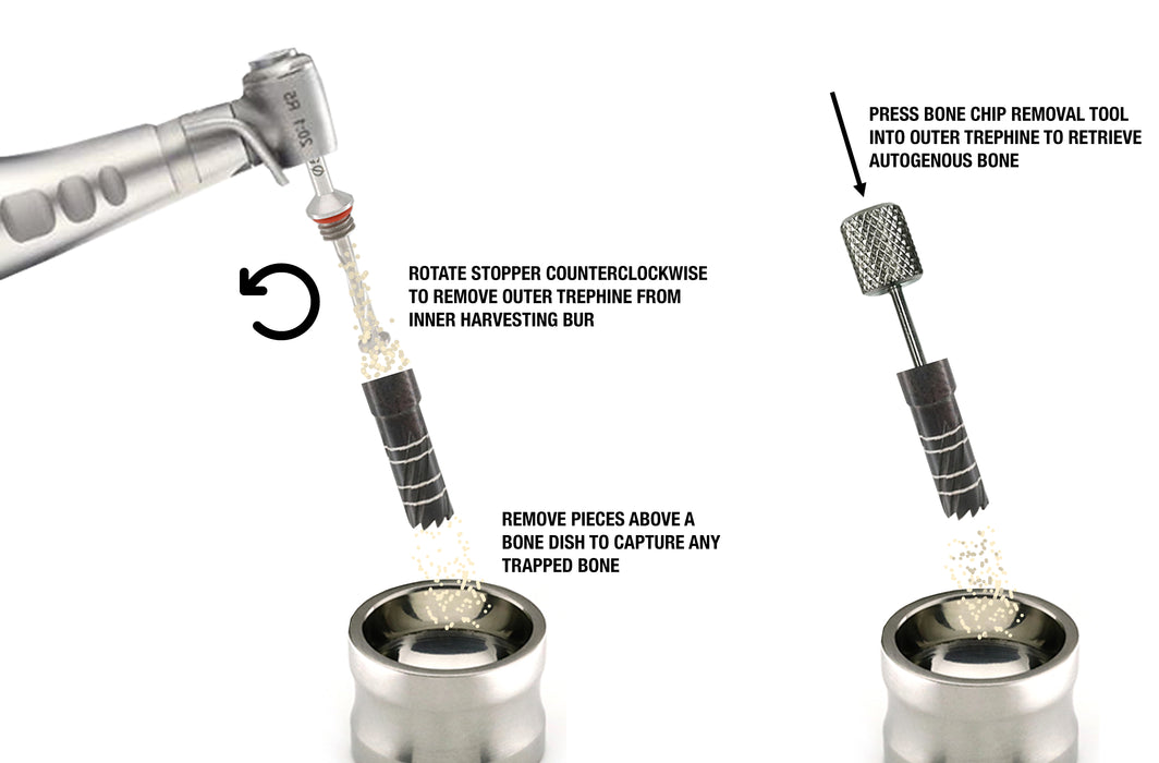 Ultimate Bone Harvesting Trephine Kit - Nexxgen Biomedical® - Avtec Dental
