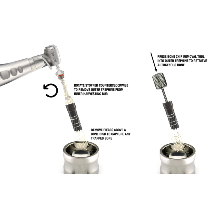 Ultimate Bone Harvesting Trephine Kit - Nexxgen Biomedical® - Avtec Dental