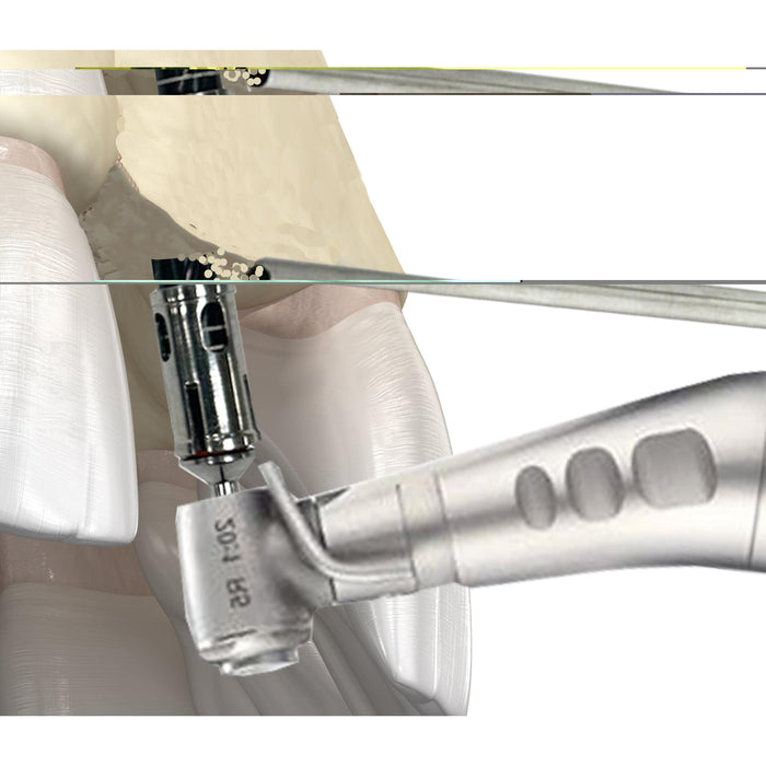 Ultimate Bone Harvesting Trephine Kit - Nexxgen Biomedical® - Avtec Dental