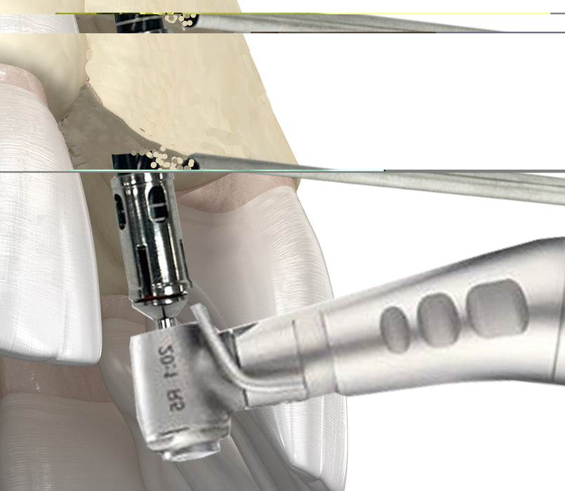 Ultimate Bone Harvesting Trephine Kit - Nexxgen Biomedical® - Avtec Dental