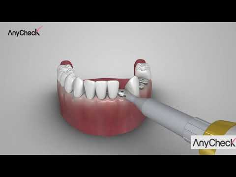 AnyCheck Implant Stability Detection Device