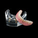 PB-1 Locator Overdenture - Avtec Dental