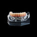 PB-6 Implant Supported Hybrid Denture - Avtec Dental