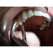TempOff® - Temporary Crown Remover - Avtec Dental