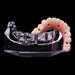 PB-6 Implant Supported Hybrid Denture - Avtec Dental